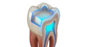 어금니의 우식 부위와 인레이 수복을 위한 와동 형성의 3D 모델링 이미지